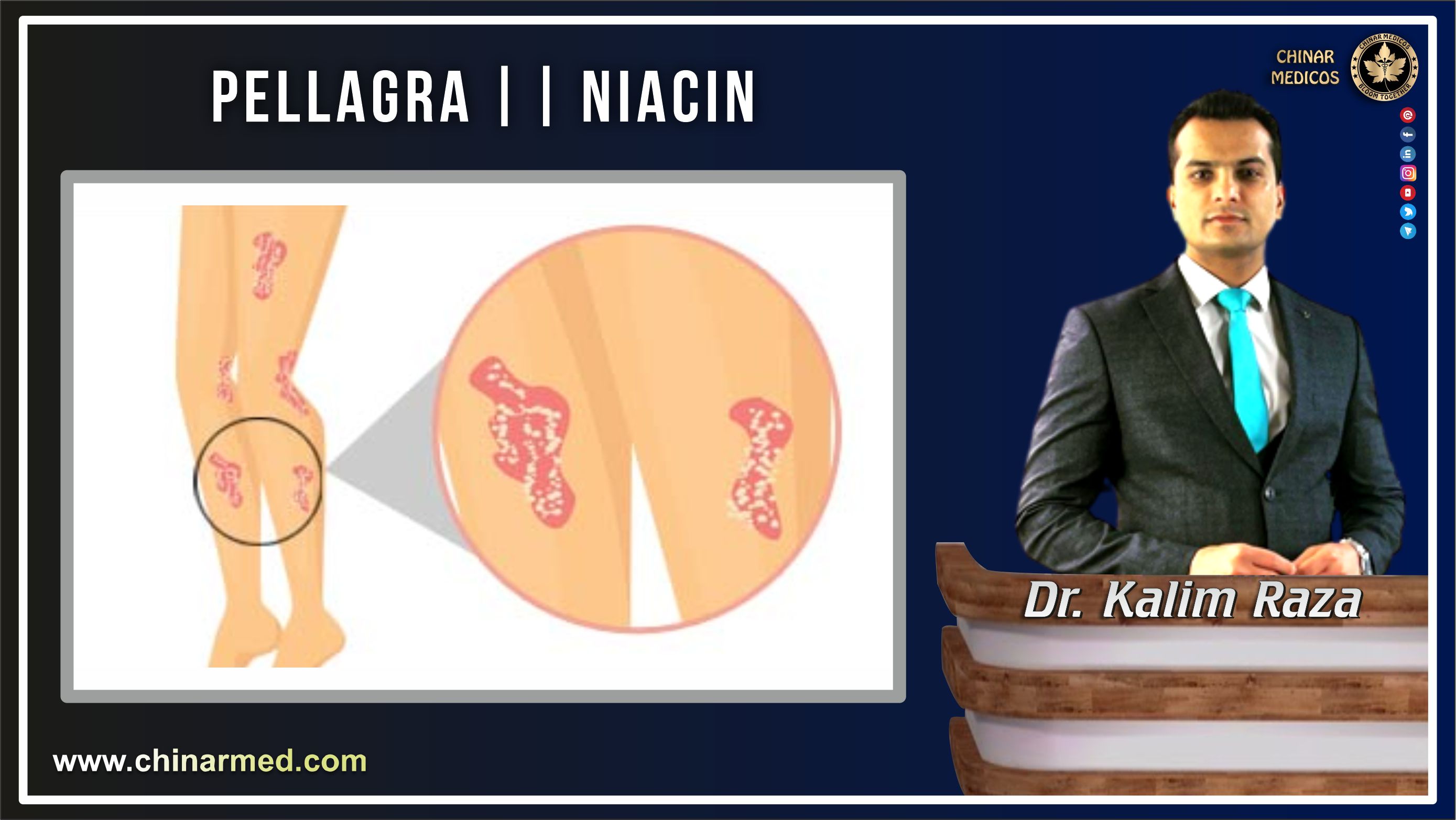 Pellagra vitamin B3 deficiency
