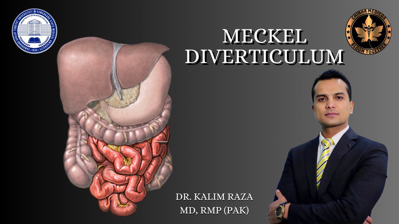 MECKEL diverticulum